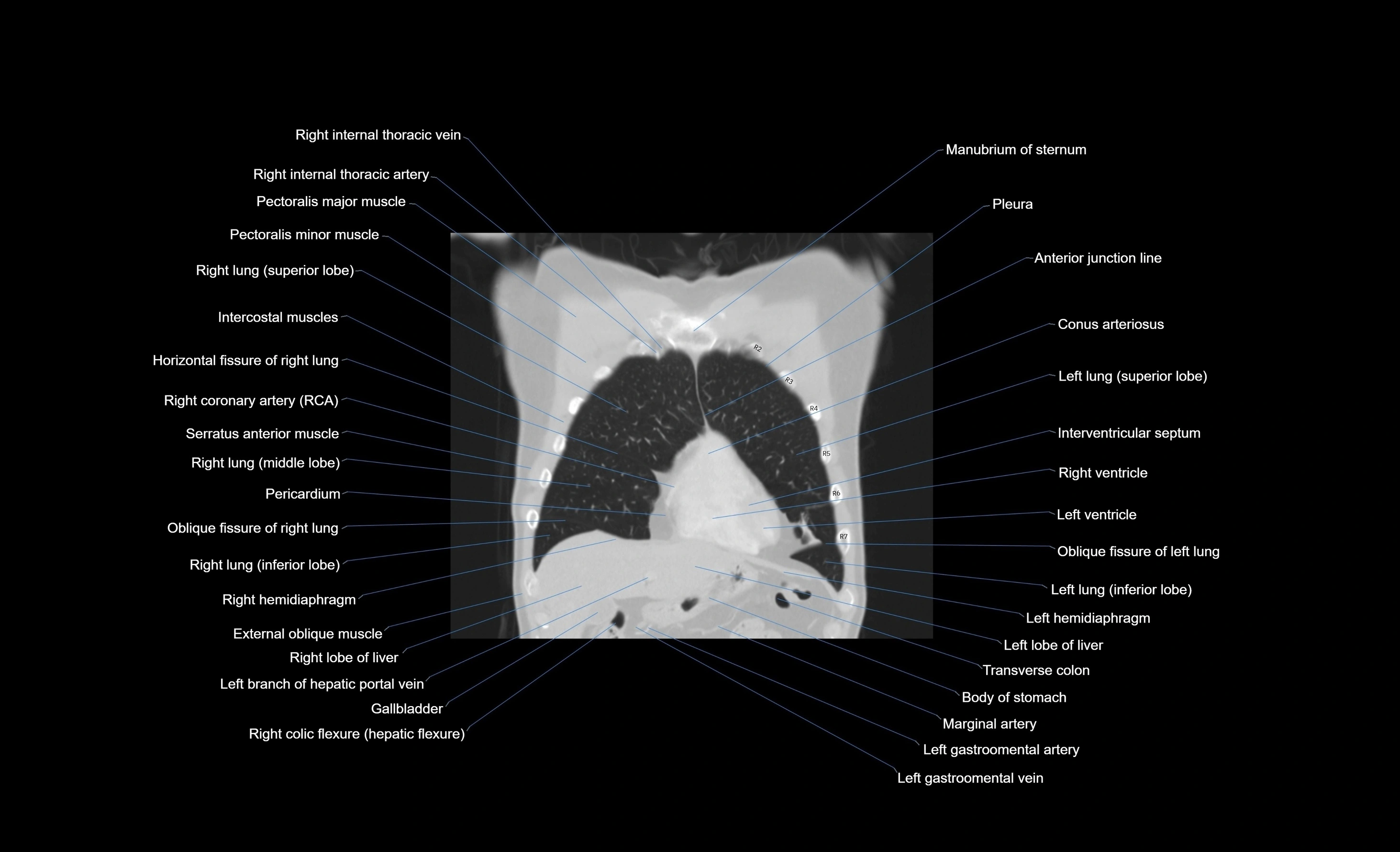 CT chest (thorax) labelled coronal cross sectional anatomy radiology image-00090.webp